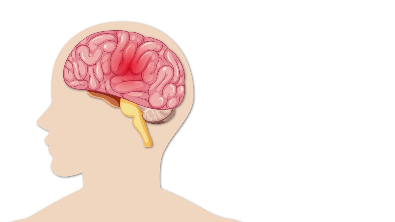 Animation illustrating atherosclerosis progression in brain arteries, highlighting plaque buildup and blood flow restriction over time