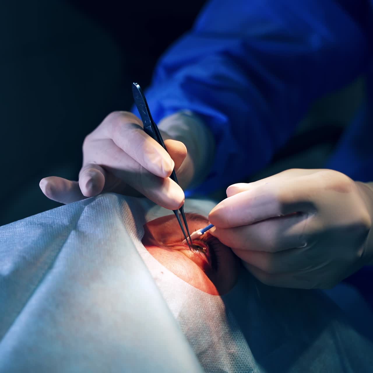Close up detail of eye surgery