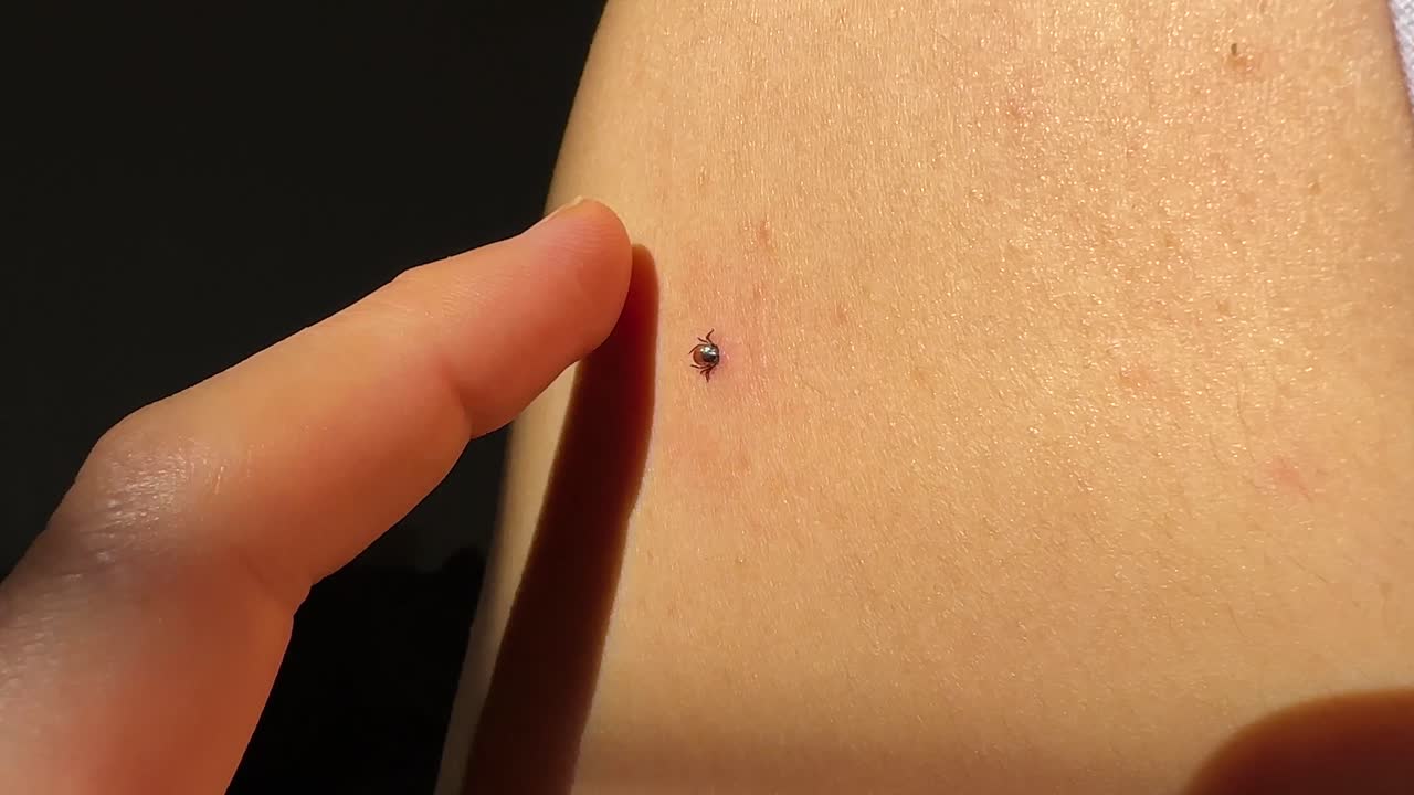 insecto chupador de sangre la garrapatura del bosque se arrastra picadura de insecto en la mujer piel suave luz del sol en el hogar en irán aldea rural campo en las tierras altas de gilan hyrcanian naturaleza paisaje concepto de enfermedades palo mordida