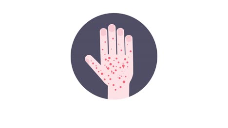 erupción de sarampión que aparece en la animación médica de la mano.