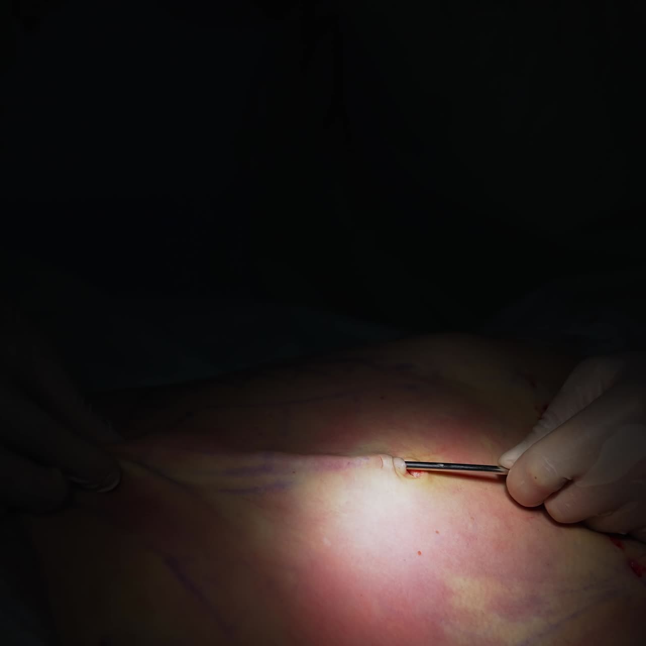 A plastic surgeon performs the operation of liposuction and liposculpture. Doctor using the special tool for liposuction procedure in the dark operating room