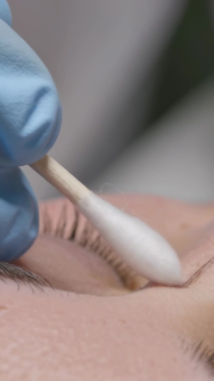 Video verticale: Tecnico con guanti in nitrile blu che porta un tampone e pulisce un occhio chiuso in clinica, rimuovendo un segno.