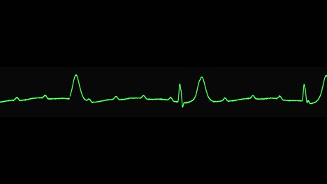 el ecg muestra arritmia completa de bloque av