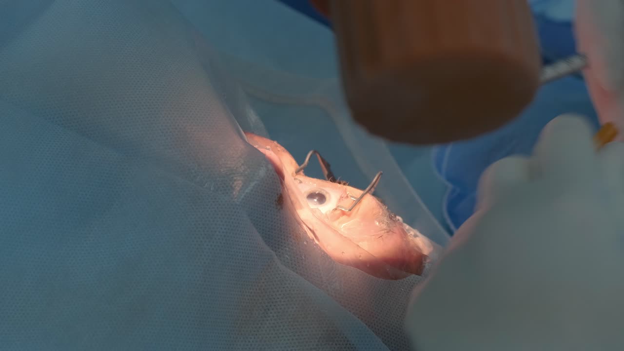 хирургия катаракты вблизи. хирург, оперирующий катаракту глаза в больничной хирургии