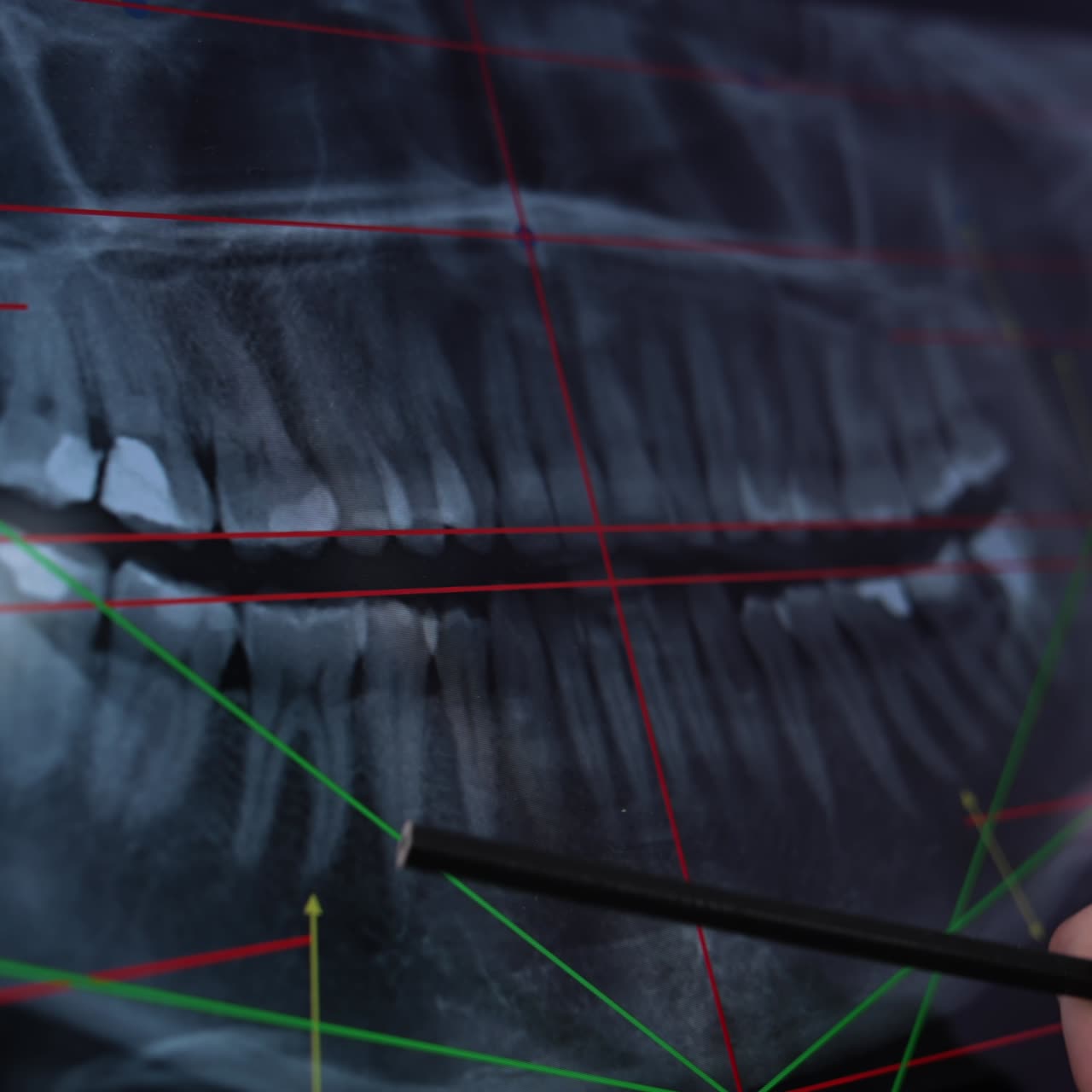 Macro shot of x-ray picture of denture on the screen of computer. Doctor's hand pointing at teeth with a pencil. Close up