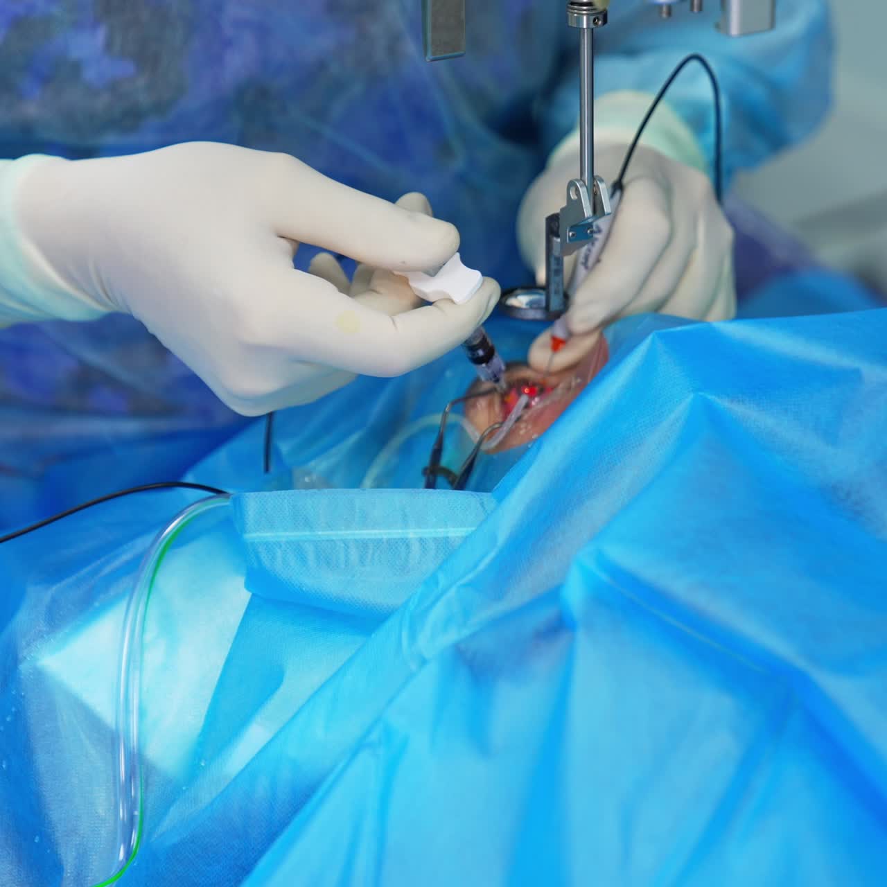 Eye operation in process. Surgeon's hand makes an injection with a syringe into patient's eyeball. Close up