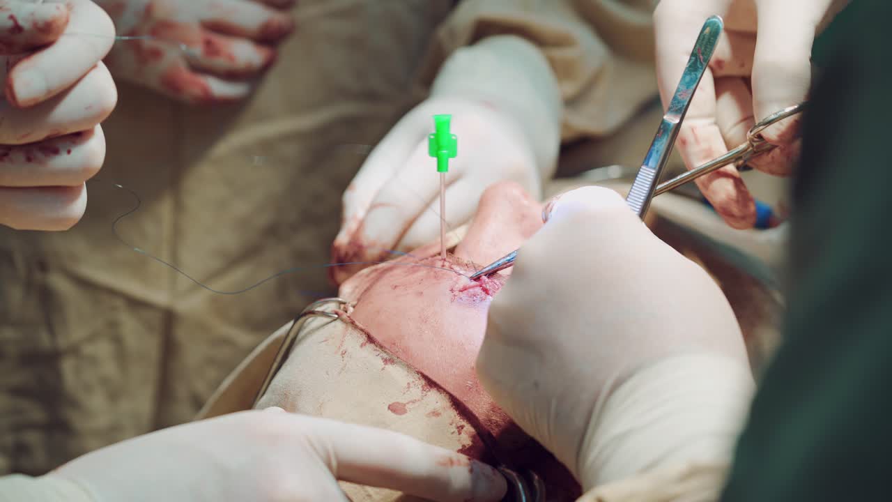 Hands of surgeons are making stitches on the deep wound of patient in the operating room. Close-up.