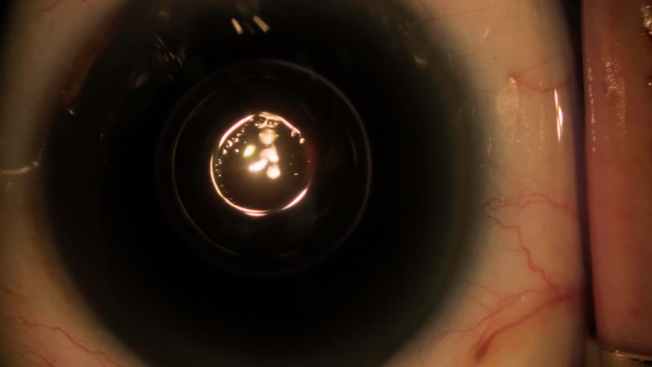 cirugía ocular, vitreoretinal, cirugía de vitrectomía.