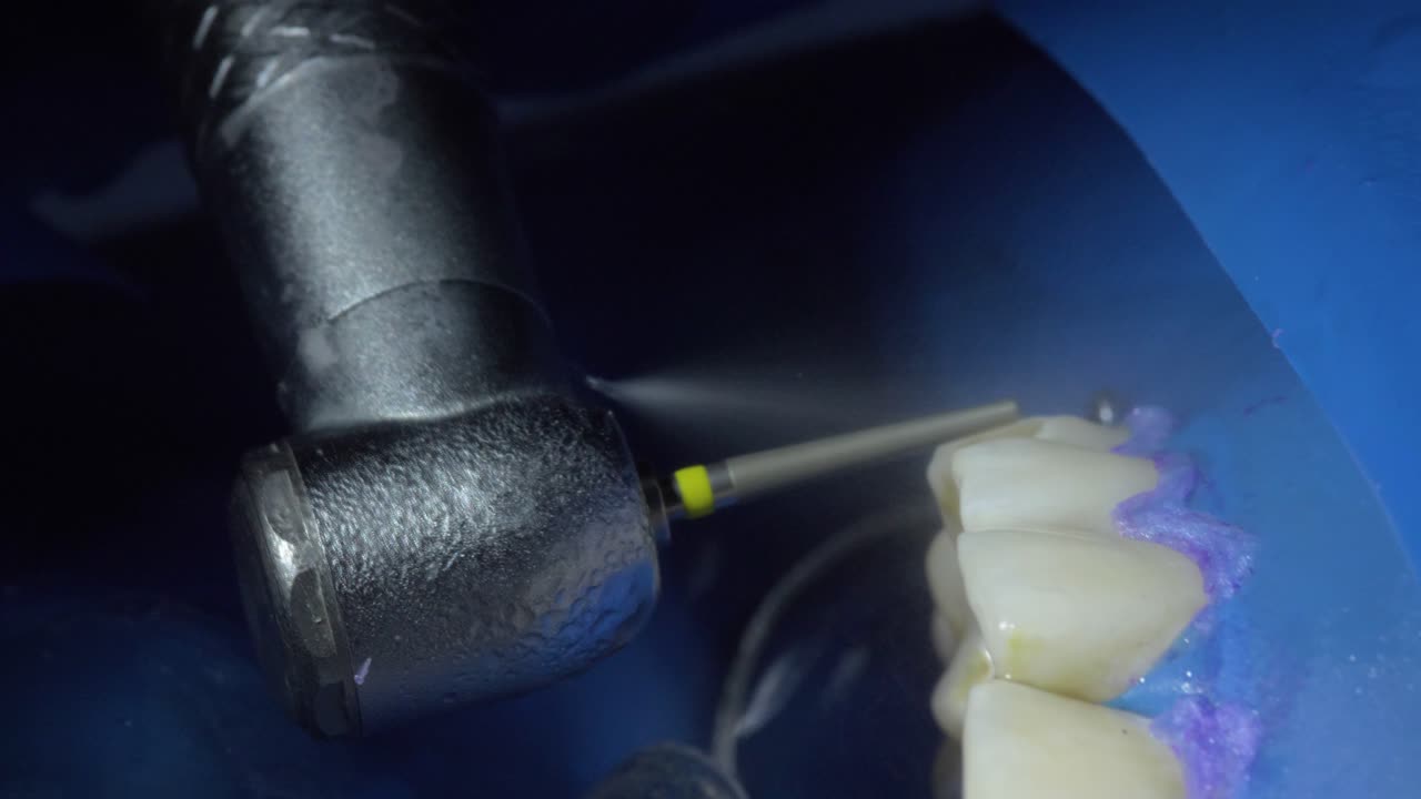 Pulizia efficiente delle protesi dentarie con tecnologia aerotor in questo accattivante filmato di repertorio