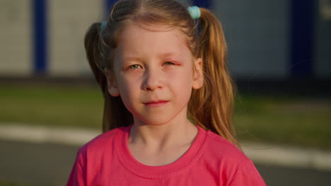 little girl with allergy on insects bites stands on street