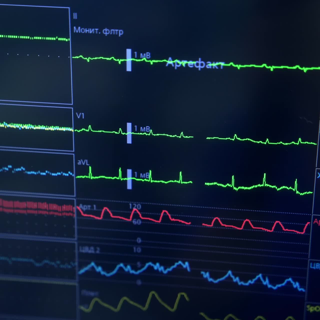 Patient's life signs on the equipment monitor. Controlling and checking the condition of a person under surgery. Extreme close up