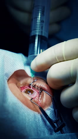 laser modern cataract surgery. professional ophtalmology healthcare. vertical video