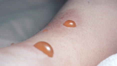 Closeup-Of-Infected-Blisters,-Swollen-With-Fluid-Requiring-Medical-Treatment-In-Hospital
