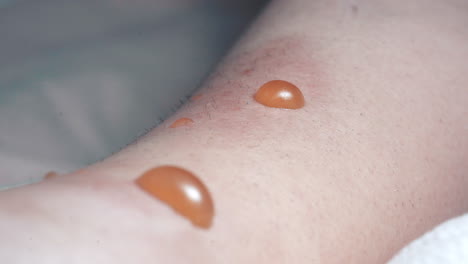 closeup of infected blisters, swollen with fluid requiring medical treatment in hospital