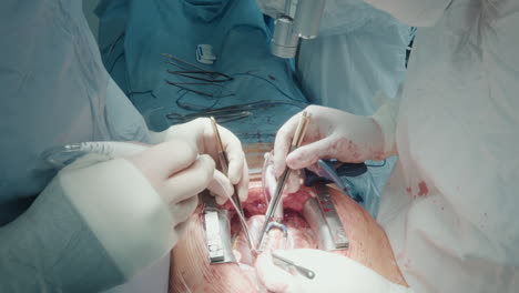 cardiothoracic surgeons operate patient. skilled medics use endoscopic instruments for grafting harvested vessels creating new pathway for blood flow