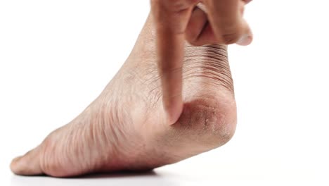 Close-up-of-young-men-dry-feet-isolated-on-white-,