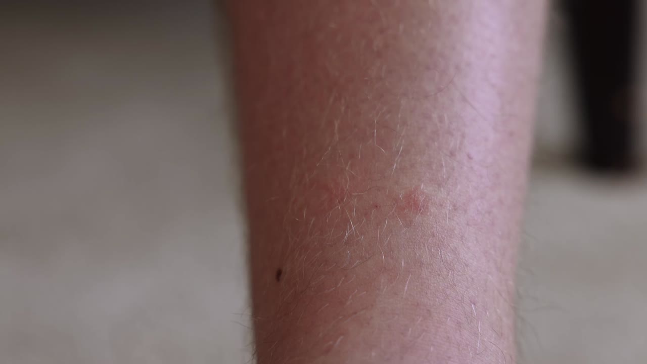 close-up shot of red marks left on a person leg after ticks being removed
