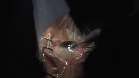 ophthalmologists perform cataract surgery in quirophan