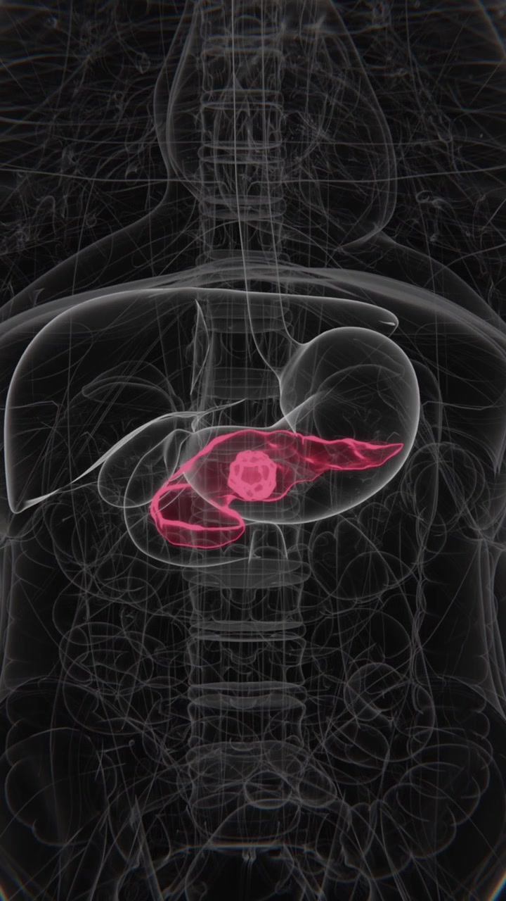 Il cancro al pancreas è un tumore maligno che si sviluppa nel pancreas, un organo coinvolto nella digestione e nella regolazione della glicemia, in Video Verticale UHD.