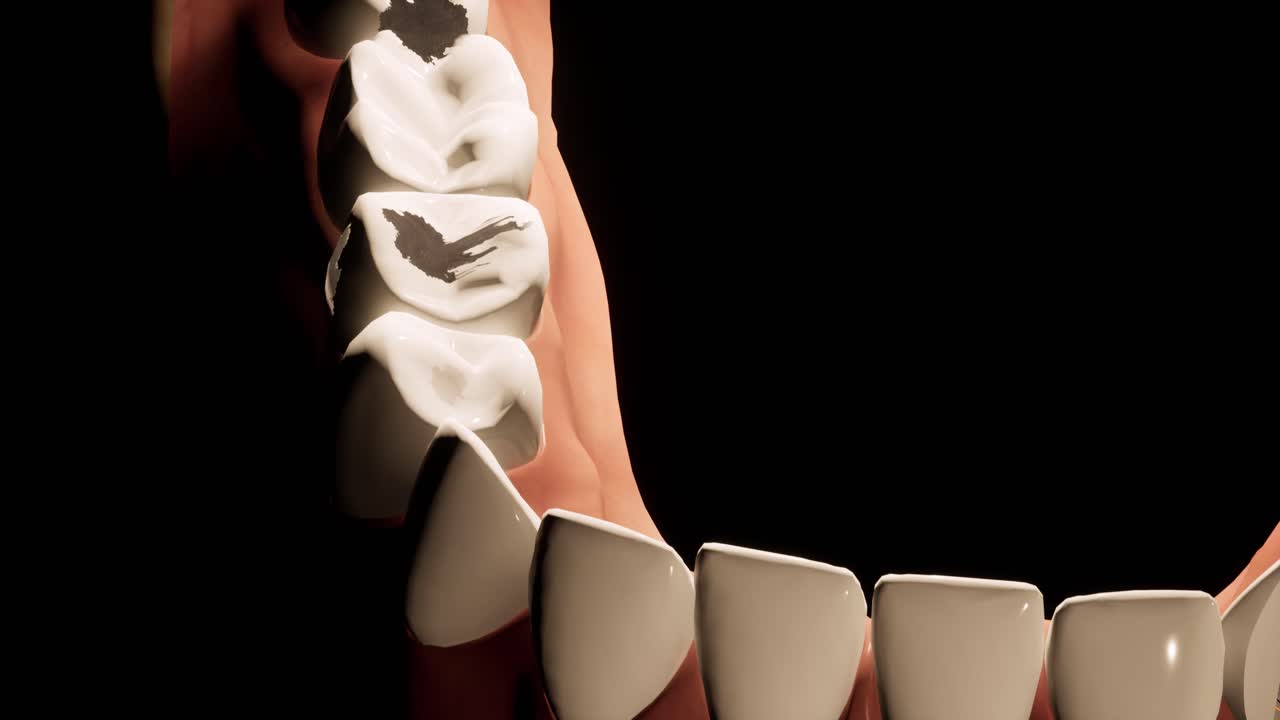질로 손상된 치아 3d 애니메이션