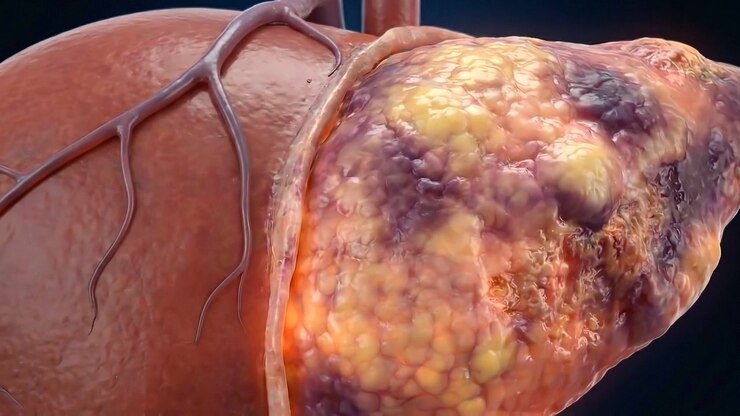 Textured isolated human liver with dark damaged surface regions in medical view