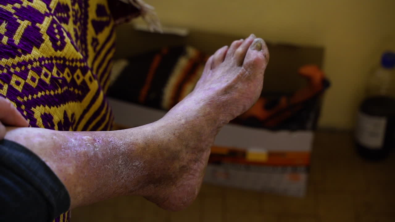 A very sick leg of an old man