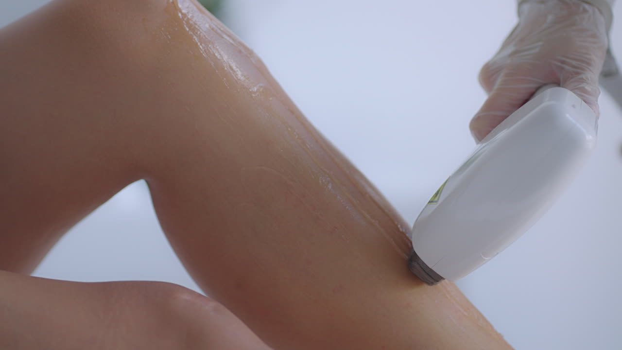 코스메톨로지스트는 환자의 다리에 레이저 탈모를 수행합니다. 탈모 절차. 여성 다리의 레이저 탈머리 절차. 장갑을 입은 의사.