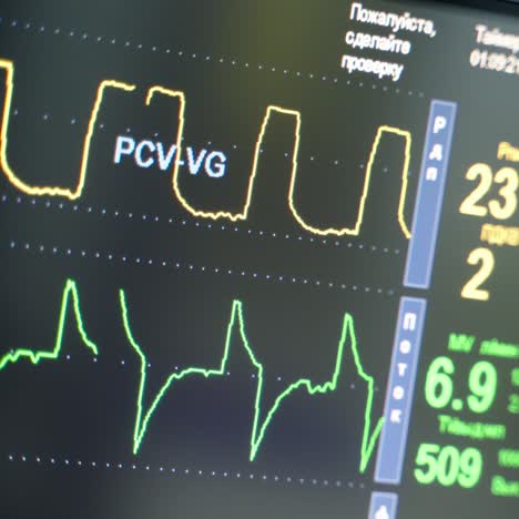 motion of graphs on a heart rate monitor. medical monitor shows vital signs of a patient in operating room. close-up