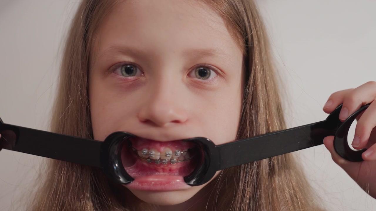 Primo piano di una giovane ragazza che tiene un divaricatore ortodontico dentale per mostrare il suo apparecchio. La scena è ambientata al chiuso con illuminazione soffusa, con i lunghi capelli e le mani del soggetto visibili mentre la ragazza si sistema.