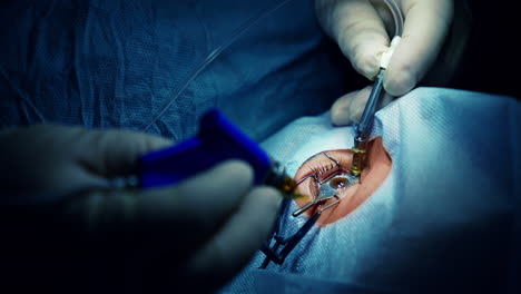 operating room during ophthalmic surgery. surgeon hands in gloves performing laser eye vision correction