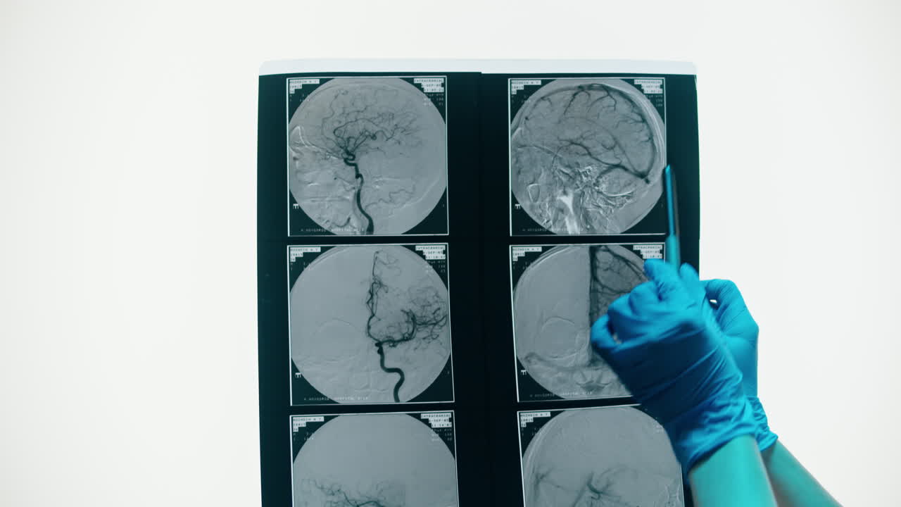 Doctor's Hands in Blue Gloves Examining Brain Scan Film