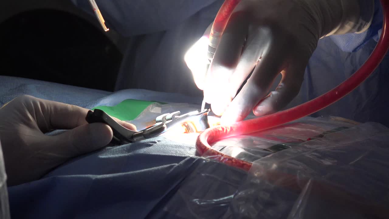 la hernia de disco espinal es una lesión en el tejido conectivo y de amortiguación entre las vértebras, generalmente causada por una tensión excesiva o un traumatismo en la columna.