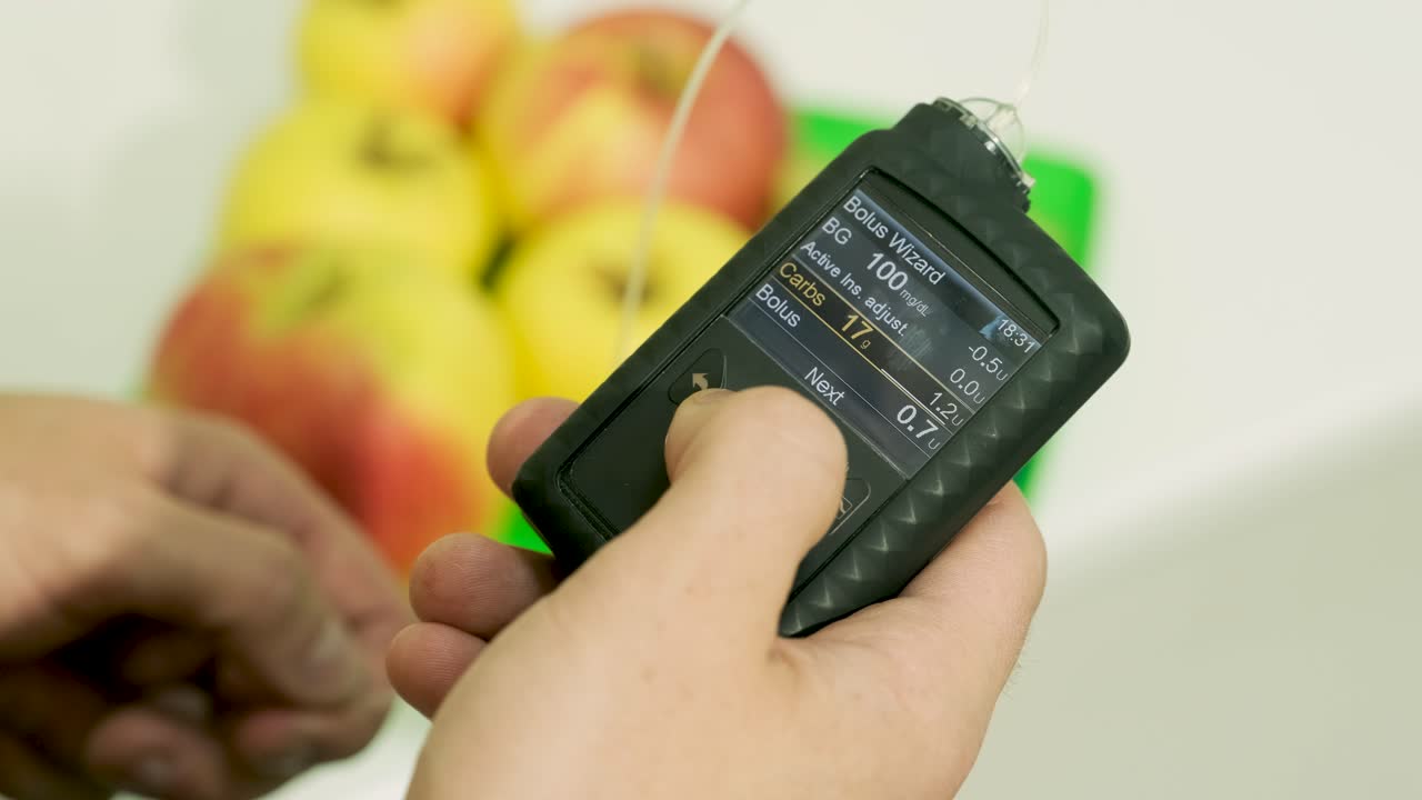 hombre diabético con una bomba de insulina conectada en su abdomen y sosteniendo la bomba de insulina en sus manos. concepto de diabetes.