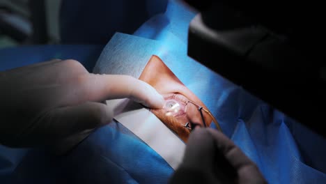 ophthalmic surgery. surgeon's hands sets an ophthalmic lens after laser vision correction