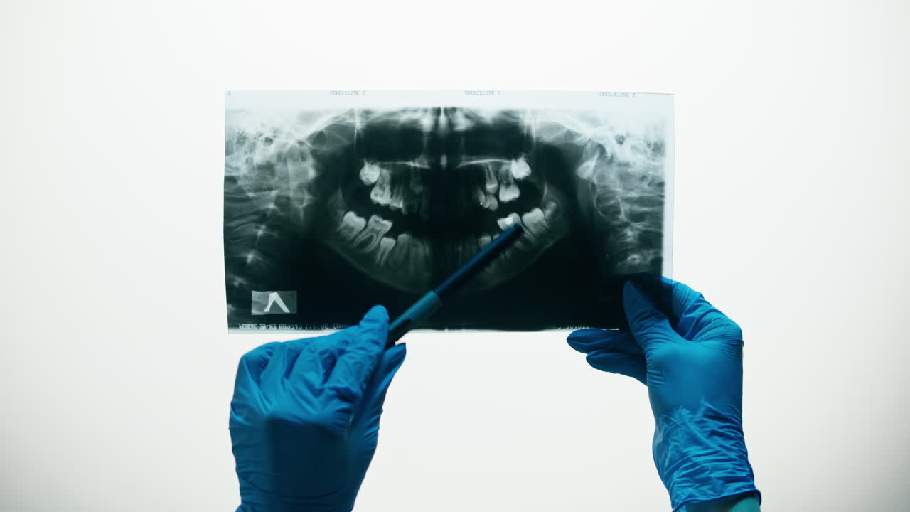 Dentist's Hands in Blue Gloves Examining a Panoramic Dental X-ray