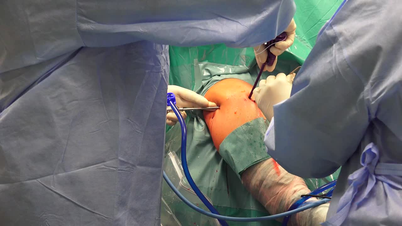 la cirugía del hombro es un medio para tratar los hombros lesionados