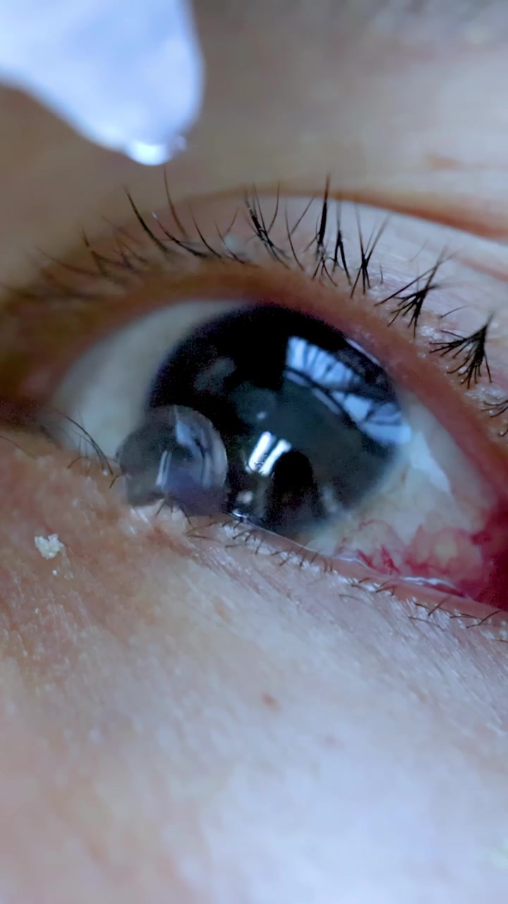 Macro primo piano di un occhio umano irritato che riceve gocce oculari idratanti, con movimento minimo della telecamera.