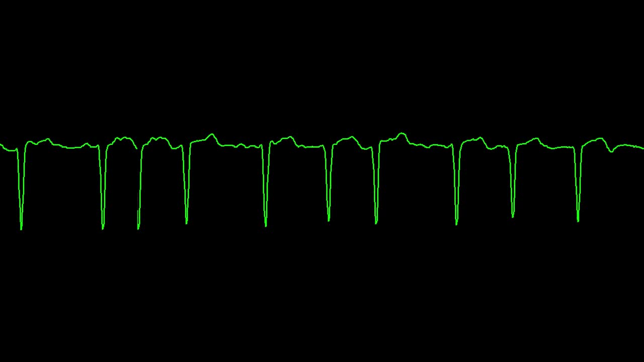 el ecg muestra fibrilación auricular arritmia