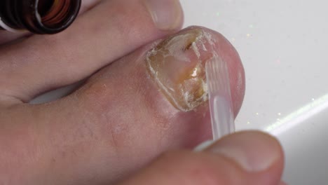 mycosis on big toe nail treatment with medicated antifungal nail polish. close up