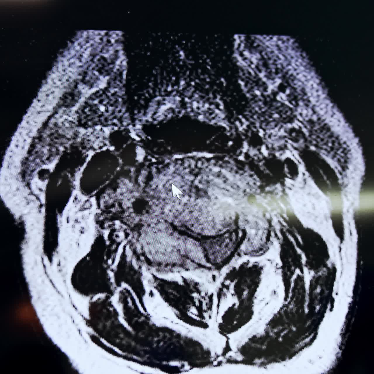 Scansioni MRI che cambiano sullo schermo del computer. Risoluzione di problemi neurochirurgici in sala operatoria. Primo piano