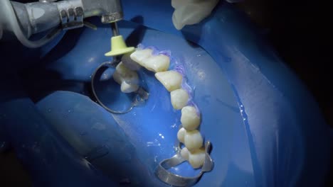 Explore-precise-teeth-cleaning-techniques-as-a-dentist-expertly-uses-tools-in-this-footage