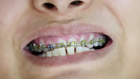 young girl showing her teeth bracing to dentist from flat angle