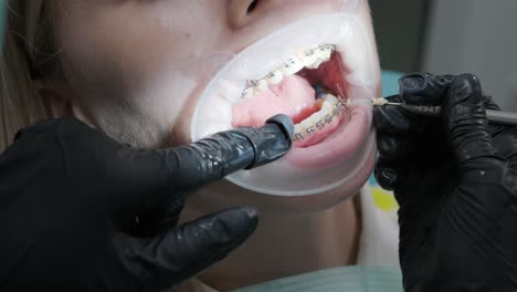 close up of dentist hand using dental forceps while putting orthodontic braces on female patient teeth. woman having dental procedure in clinic. concept of dentistry and orthodontic treatment.