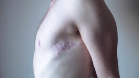transgender man showing surgery scars on chest
