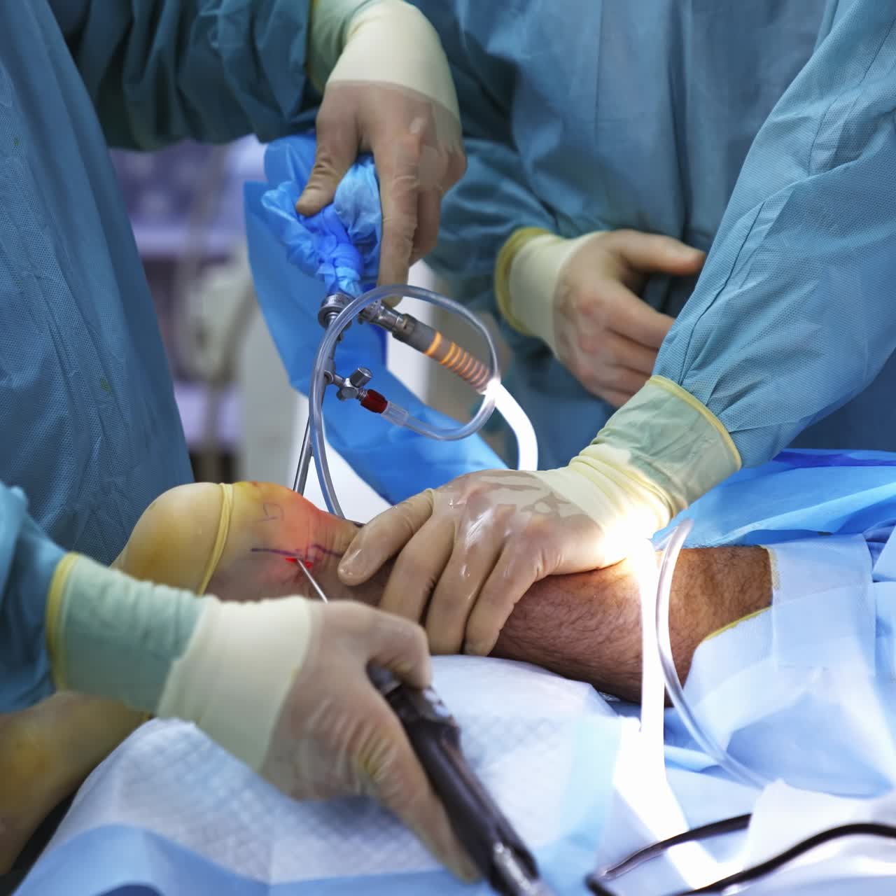 Group of surgeons in operating room with surgery equipment. Process of trauma surgery operation