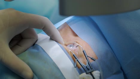 corrección de la visión con láser. un paciente y un equipo de cirujanos en la sala de operaciones durante una cirugía oftalmológica