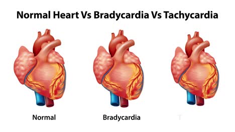 animation comparing normal, slow, and fast heart rates.