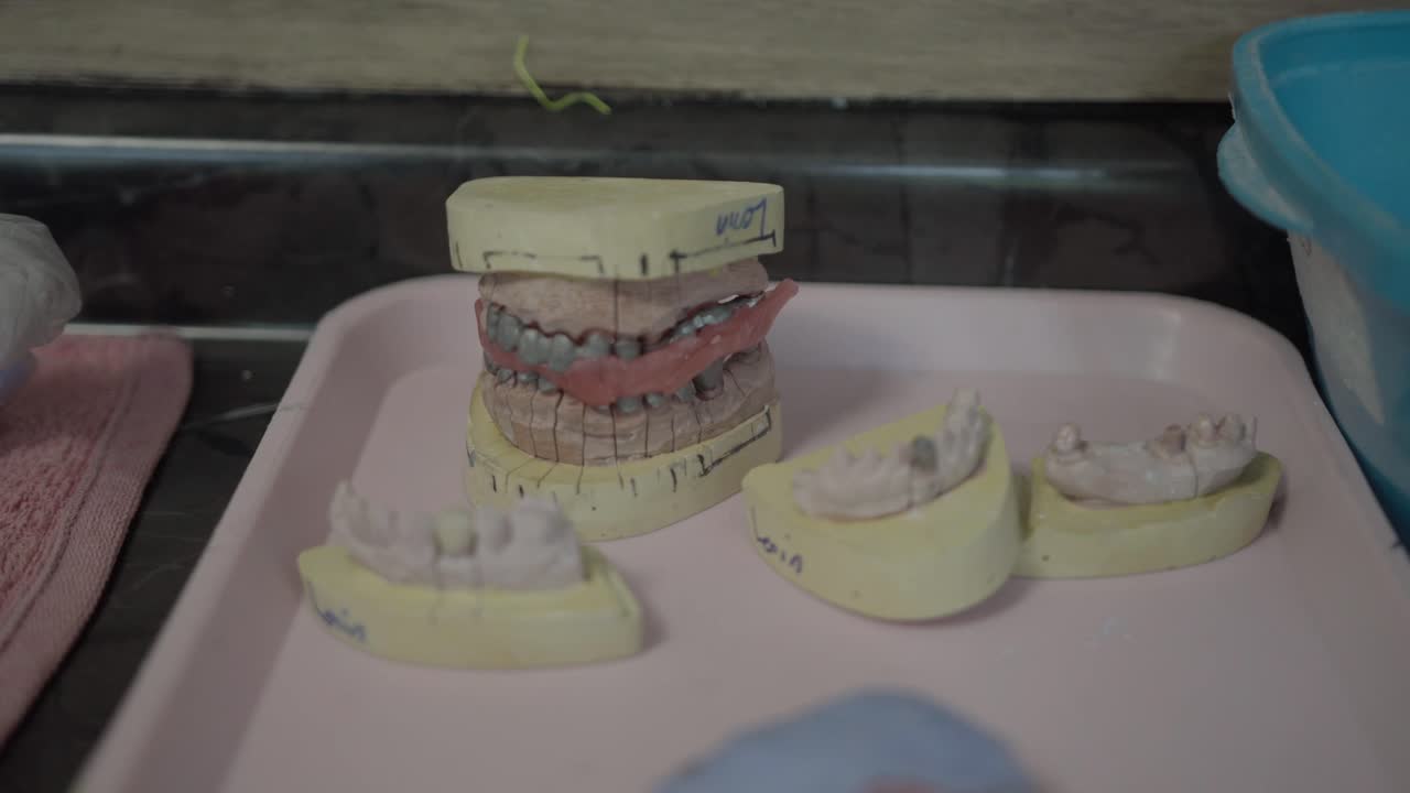 Dental plaster casts and impression molds on a tray in a clinic lab, showing teeth models used for prosthodontic planning, aligners, and denture fitting workflow