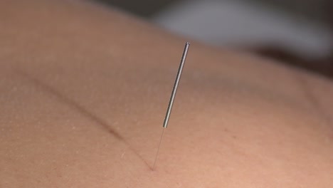 acupuncture needle spike on the back of a woman patient