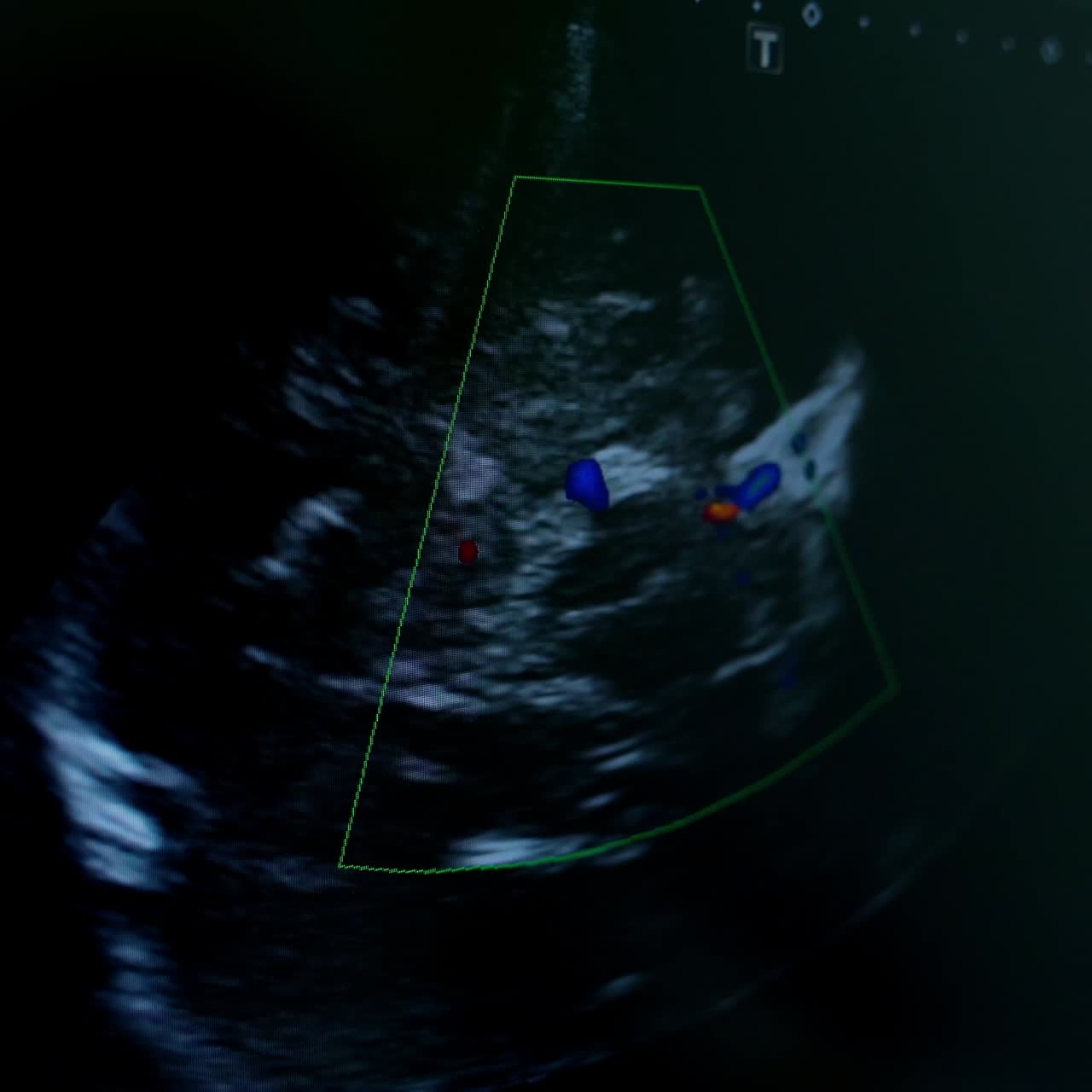 Ultrasound pictures on the screen of a computer. Monitor shows ultrasound examination of patient's organs in clinic.